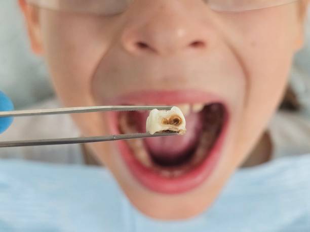 Best Broken Tooth Emergency  in Durant, IA