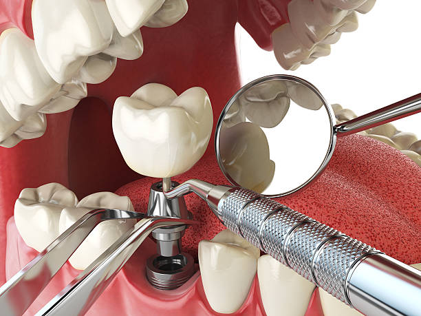 Best Cracked Tooth Emergency Dentist  in Durant, IA